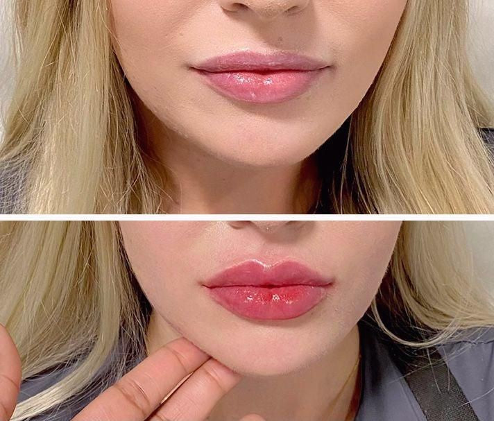 Brillo Voluminizador on Colágeno y Ácido Hialurónico - Aumenta tus labios en segundos